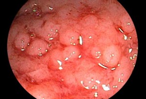 princ_rm_photo_of_scope_view_of_inflamed_colon